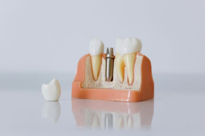 Close-up of a dental implant model featuring artificial teeth and jaw structure.